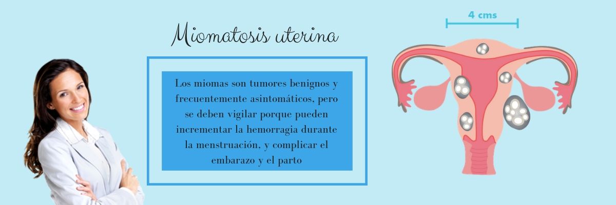 Miomatosis Uterina Sintomas Causas Y Tratamiento